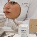 Peeling avant apres : peau avant et après, délai de récupération